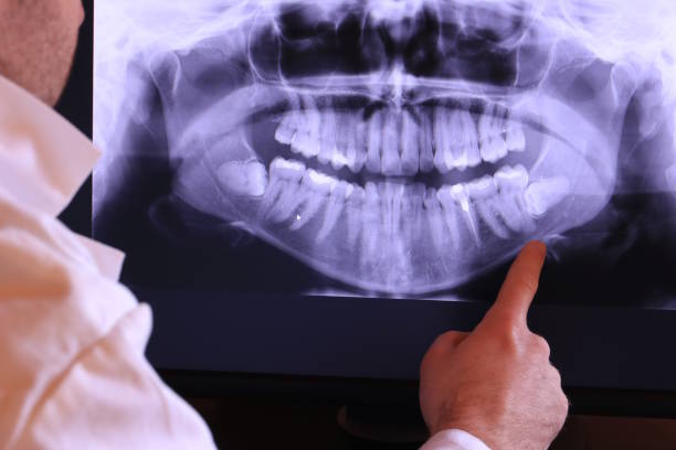 Best Knocked-Out Tooth (Avulsed Tooth) Treatment in Forest Glen, MD