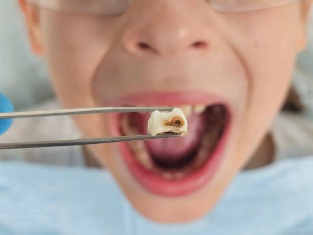Best Emergency Wisdom Tooth Extraction in Forest Glen, MD